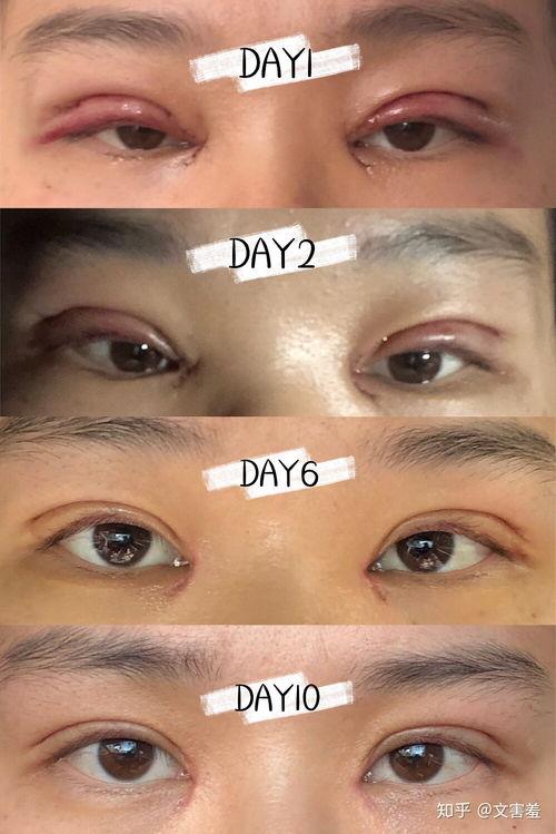 成人斜视全过程图解视频,从成因到治疗全解析